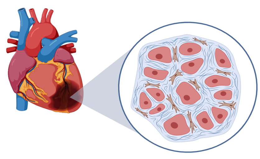 Figure 3: Diseased heart and cells following a heart attack. Cycling is one physical activity that lowers the risk of cardiovascular disease (Ref: Br J Sports Med: 2019 Jul;53(14):870-878).